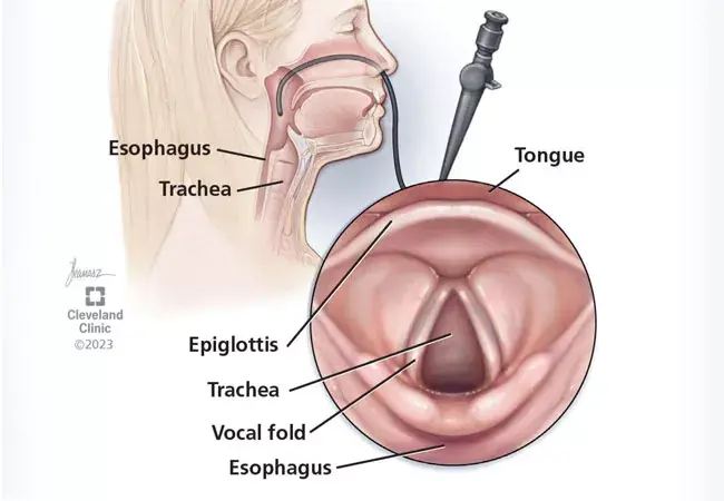 Natural Treatment for vocal cord